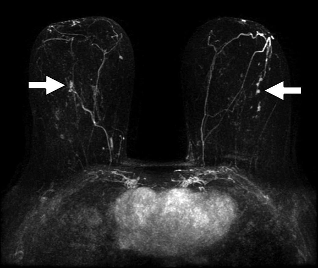 Abbreviated Breast MRI for Supplemental Screening: The Why and How of ...
